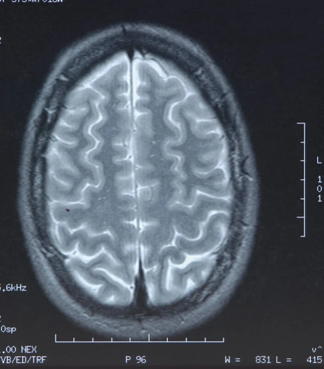 Catastrophic Personal Injury